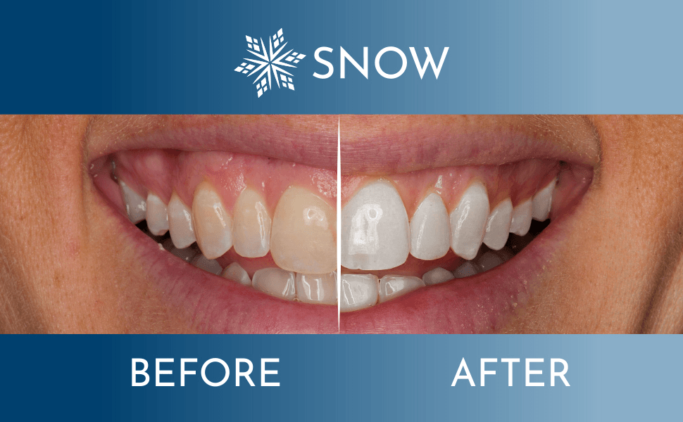 Snow 15: Competitor Comparison Secondary Images