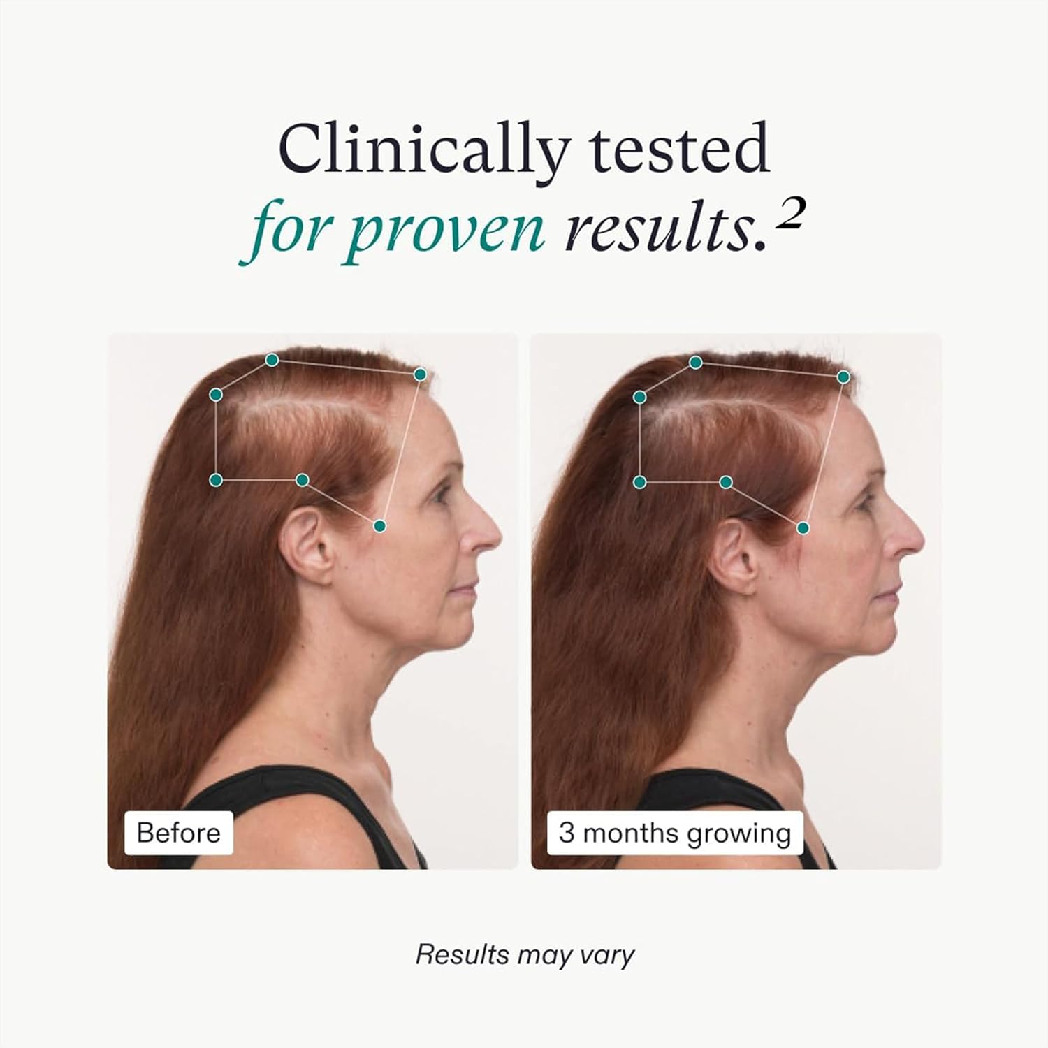 Amazon.com: Nutrafol Women's Balance Hair Growth Supplements: Infographics