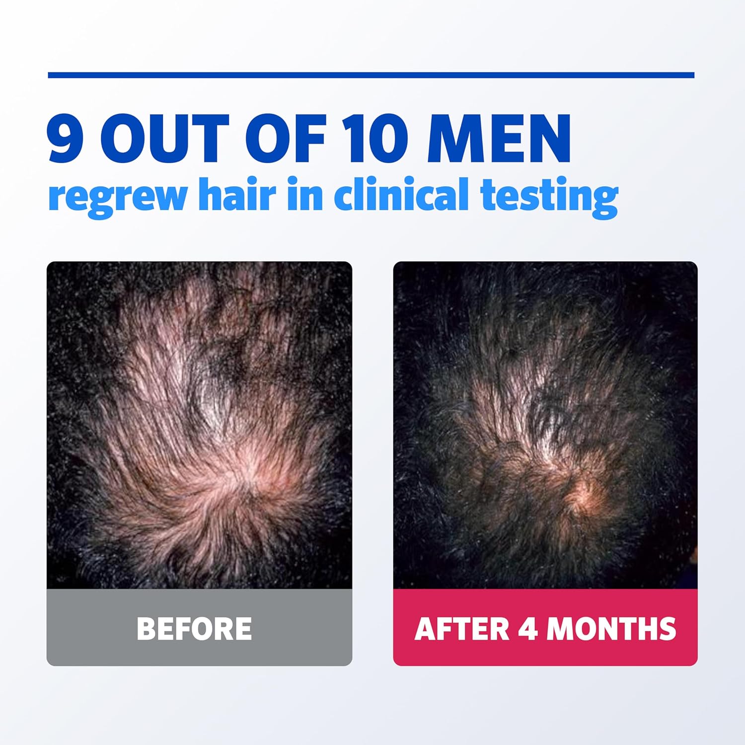 Visually demonstrates the product's effectiveness in regrowing hair over a 4-month period through a before and after comparison.