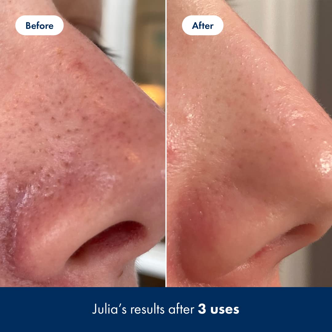 Demonstrates the effectiveness of the product in improving skin texture and reducing blemishes after just 3 uses.