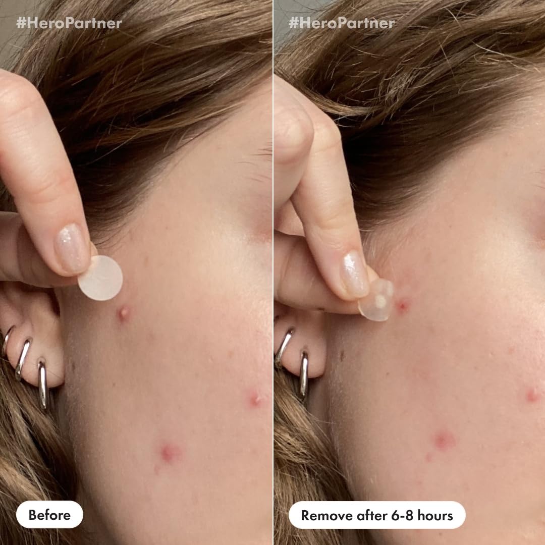 Demonstrates the effectiveness of the product in treating acne by showing a before and after comparison.