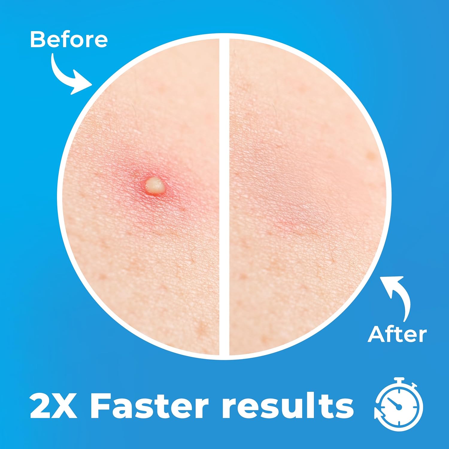 Pimple Patches for Face (120 Patches): Infographics