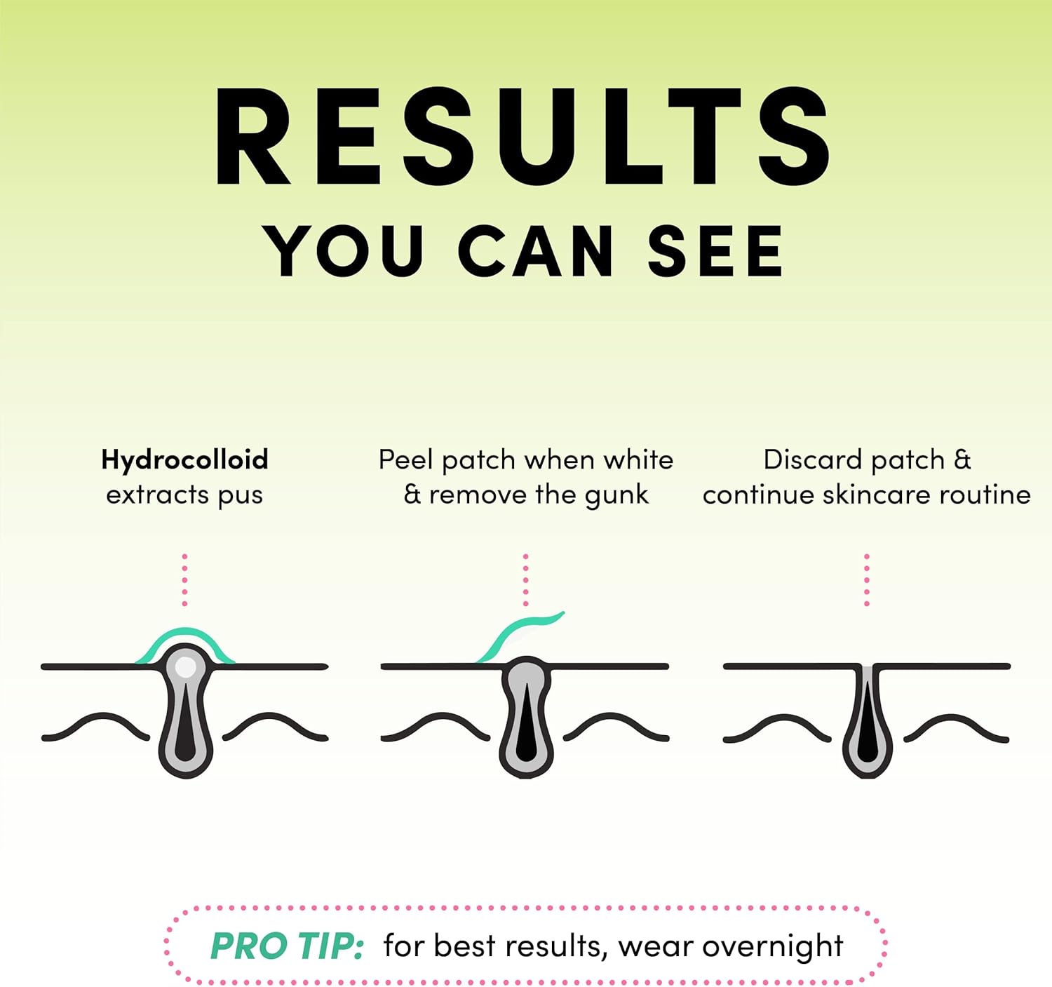 Explains the step-by-step process of using hydrocolloid acne patches, showing how they work to extract pus and when to remove them.