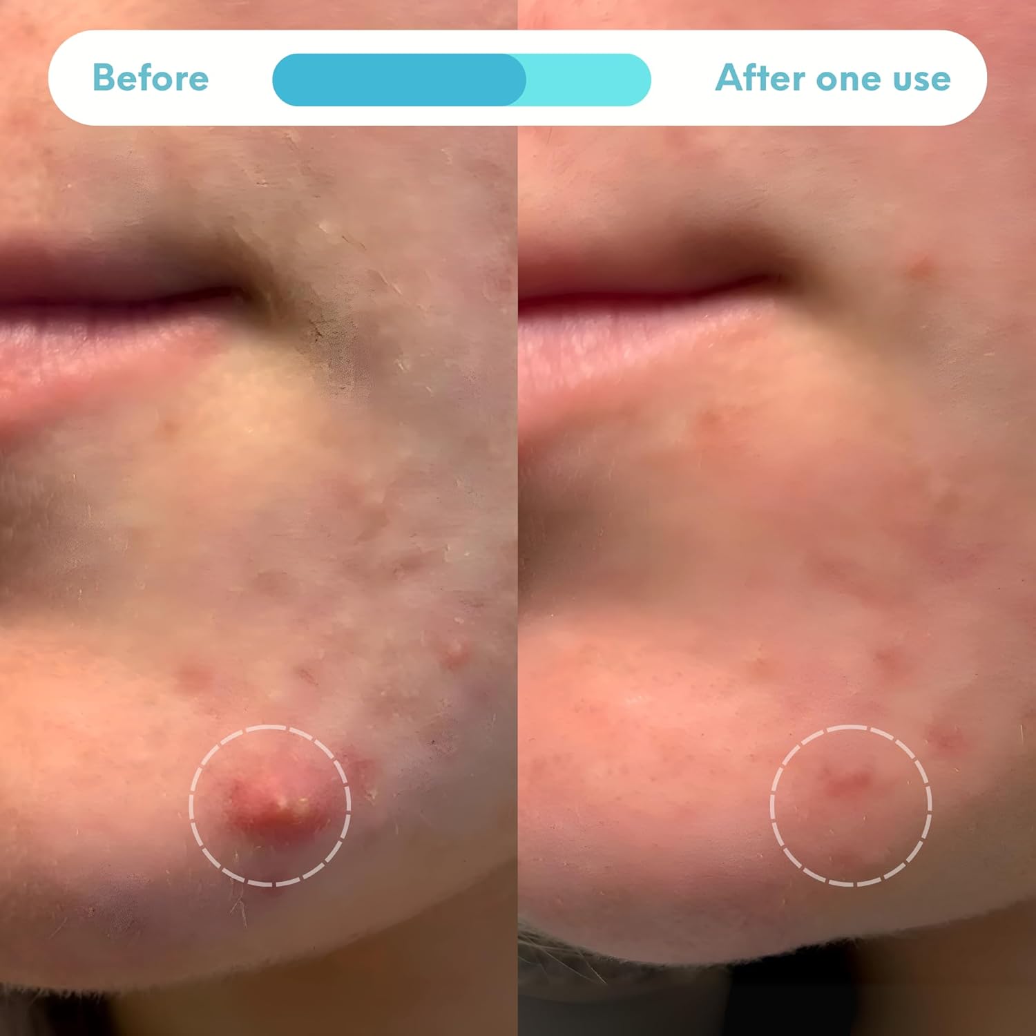 Demonstrates the rapid effectiveness of the product in reducing acne or blemishes after just one use.