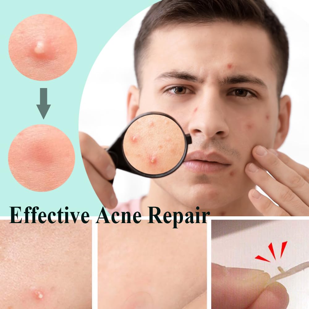Demonstrates the effectiveness of the acne repair product by showing a clear improvement in skin condition before and after use. Highlights the product's ability to effectively treat and reduce…