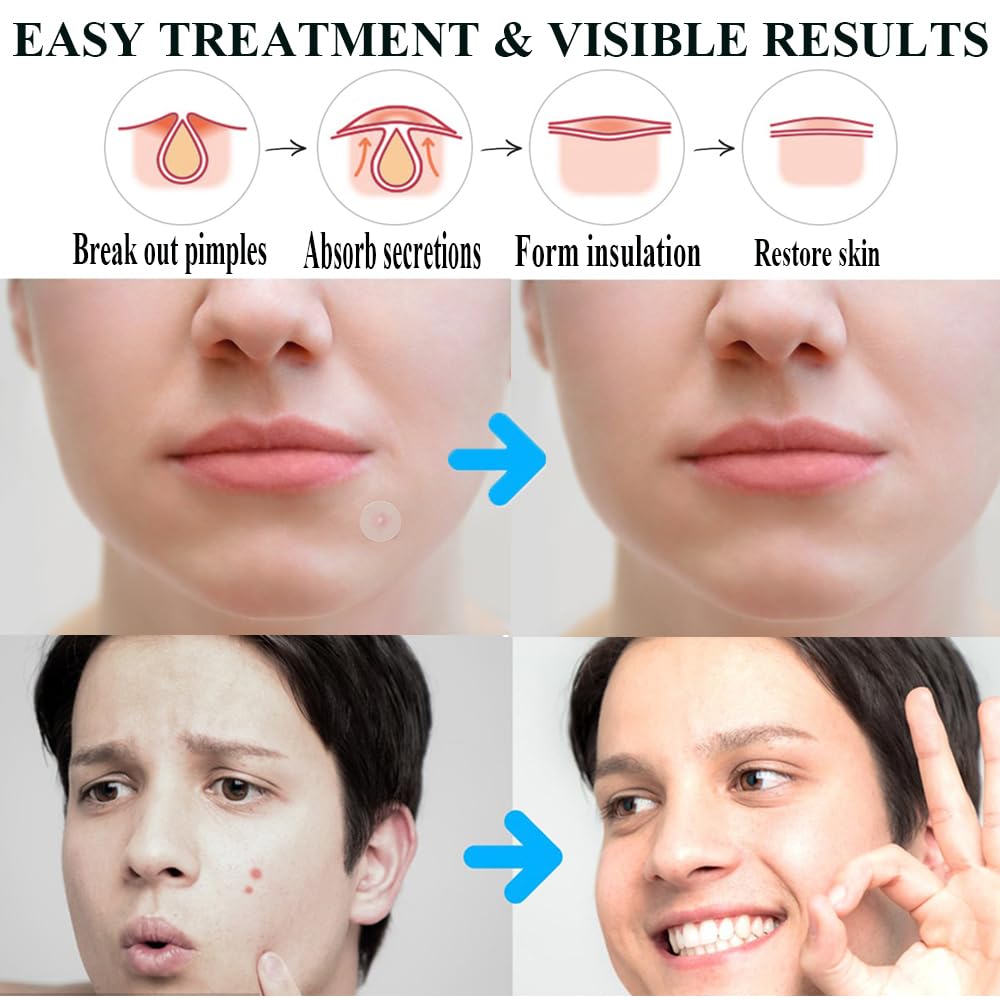 Demonstrates the effectiveness of the acne treatment product by showing visible results on skin before and after use. Explains the step-by-step process of how the acne treatment works to clear skin,…