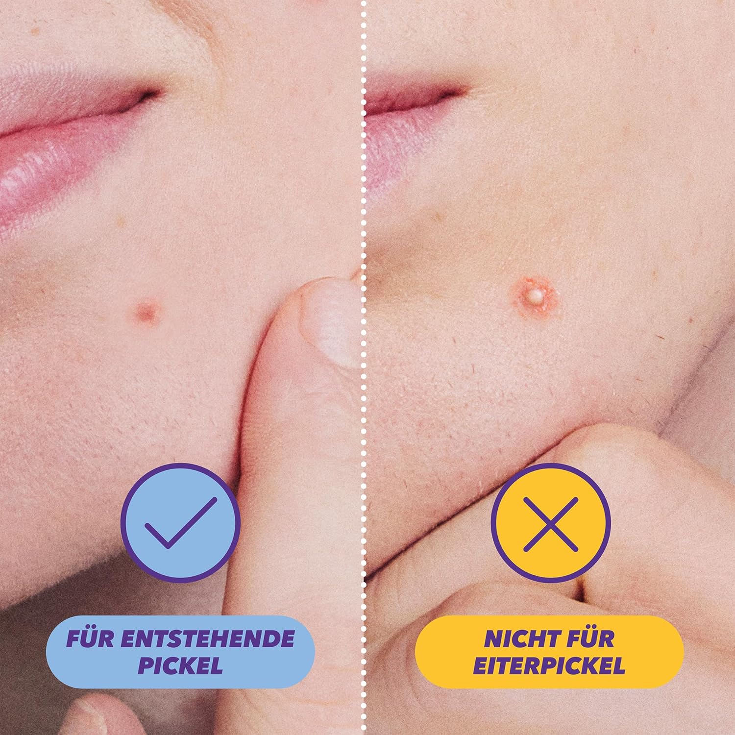 Demonstrates the effectiveness of the product in treating emerging acne versus more severe acne.