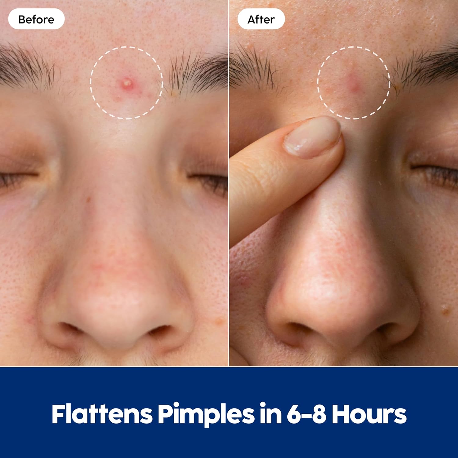 Demonstrates the product's effectiveness in reducing pimples within a short timeframe, reassuring customers of quick results.