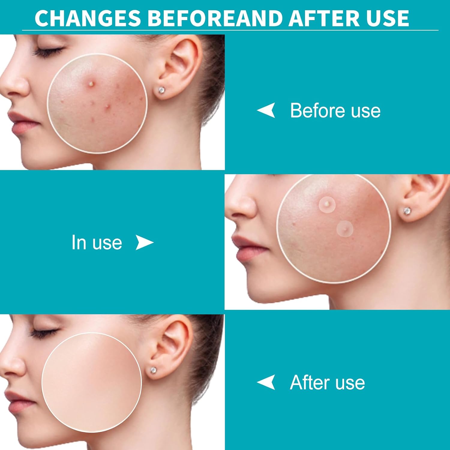 Demonstrates the effectiveness of the product in clearing acne and improving skin appearance.