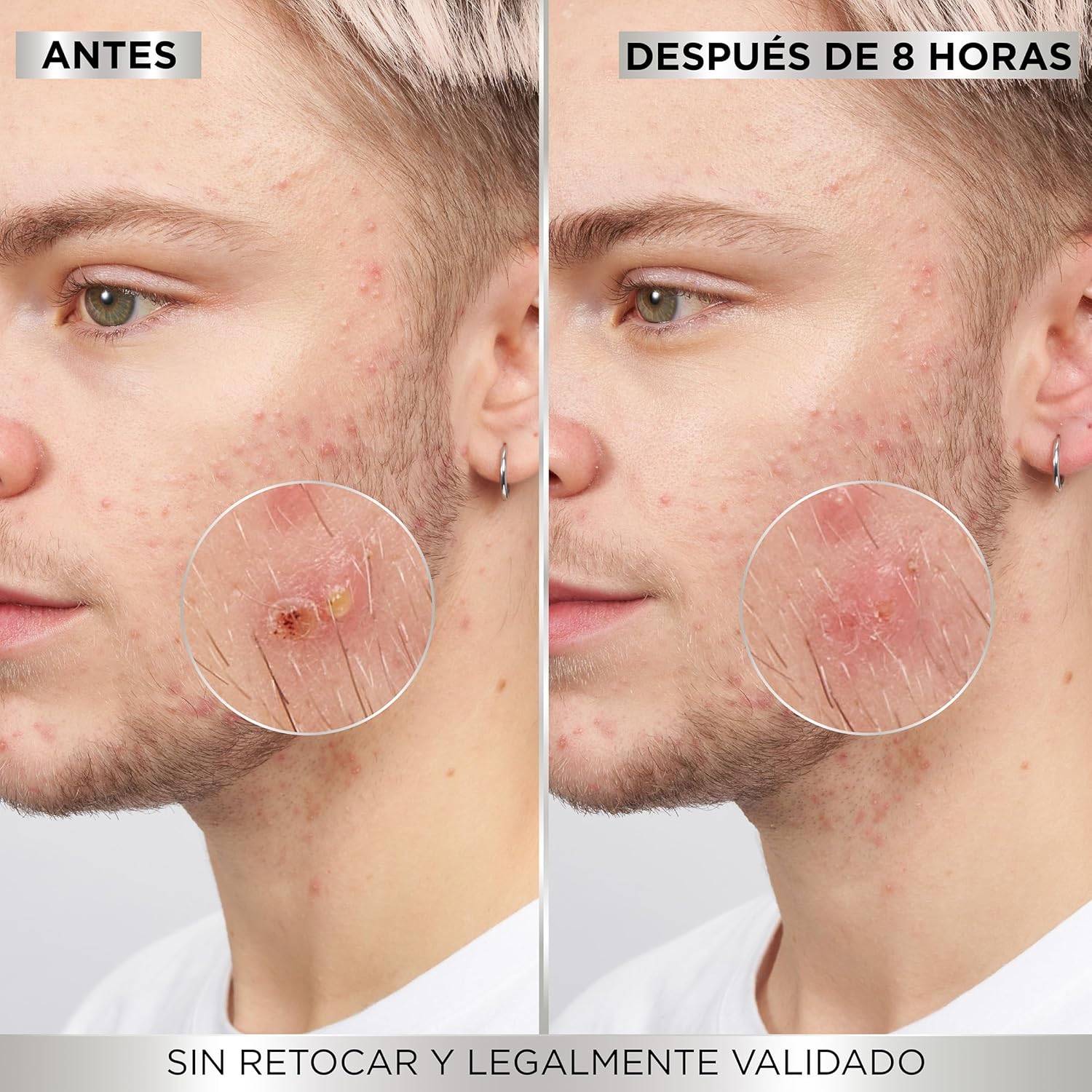 Demonstrates the effectiveness of an acne treatment product by showing visible improvement in skin condition after 8 hours of use.
