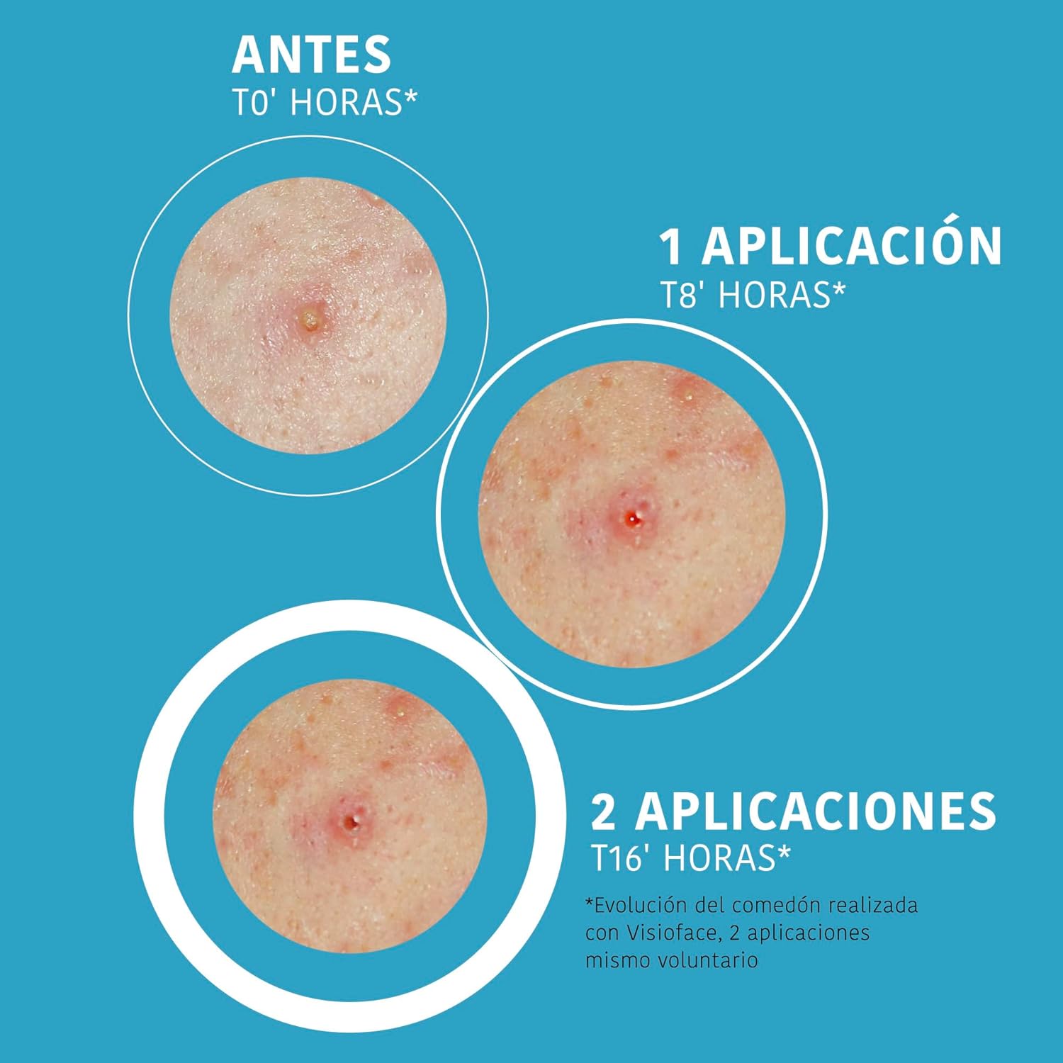 Demonstrates the effectiveness of the product in treating acne over time, showing visible improvement after 1 and 2 applications.