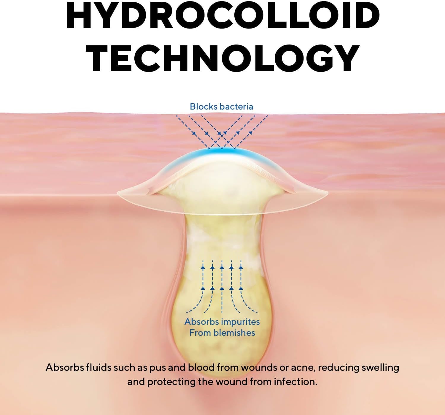 Explains how the hydrocolloid technology works to block bacteria and absorb impurities from blemishes, reducing swelling and protecting wounds from infection.
