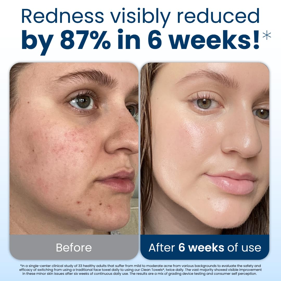 Demonstrates the effectiveness of the product in reducing facial redness and acne over a 6-week period. Quantifies the product's effectiveness with a specific statistic (87% reduction in redness) to…