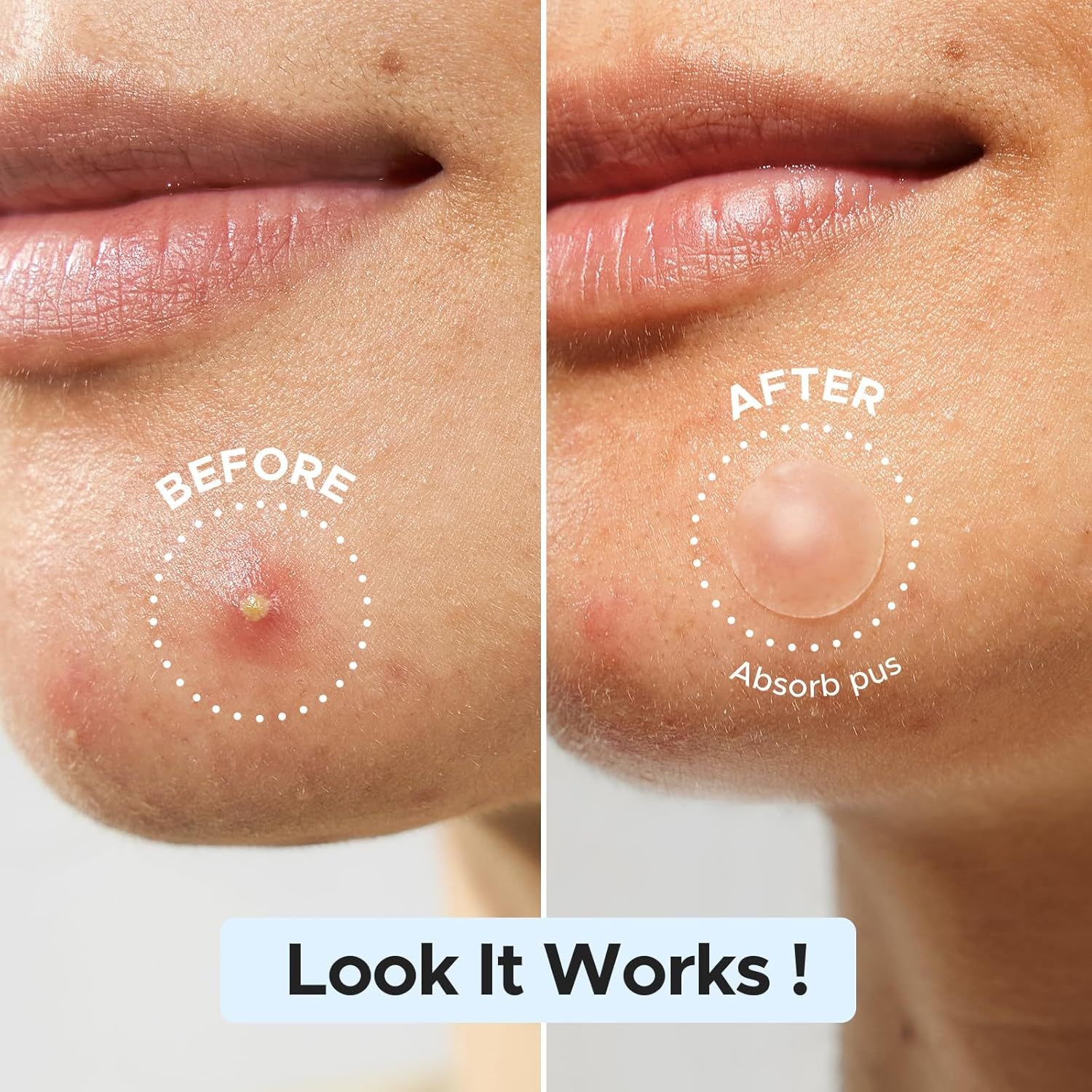 Demonstrates the product's effectiveness in healing and clearing blemishes by showing visible transformation from an active blemish to clear, smooth skin.