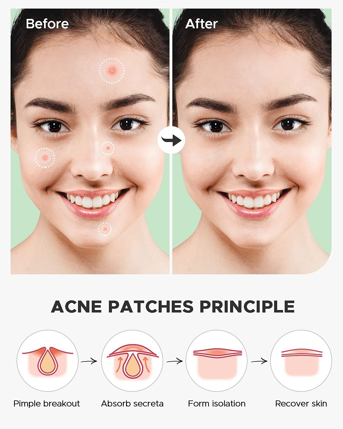Demonstrates the effectiveness of the acne patches by showing visible reduction of blemishes from before to after use, reassuring shoppers of the product's ability to clear skin. Explains the…