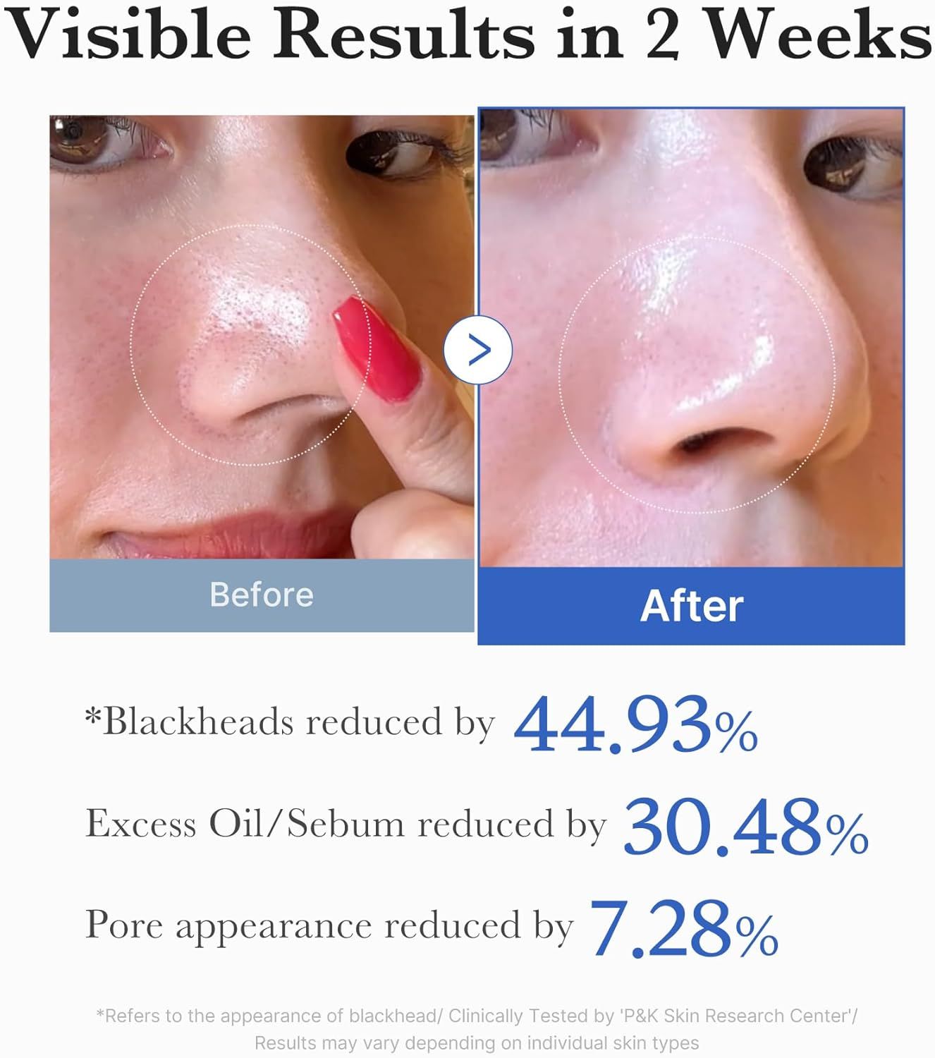 Demonstrates visible skin transformation results after 2 weeks of product use, showing significant reduction in blackheads, excess oil, and pore appearance to prove product effectiveness. Provides…