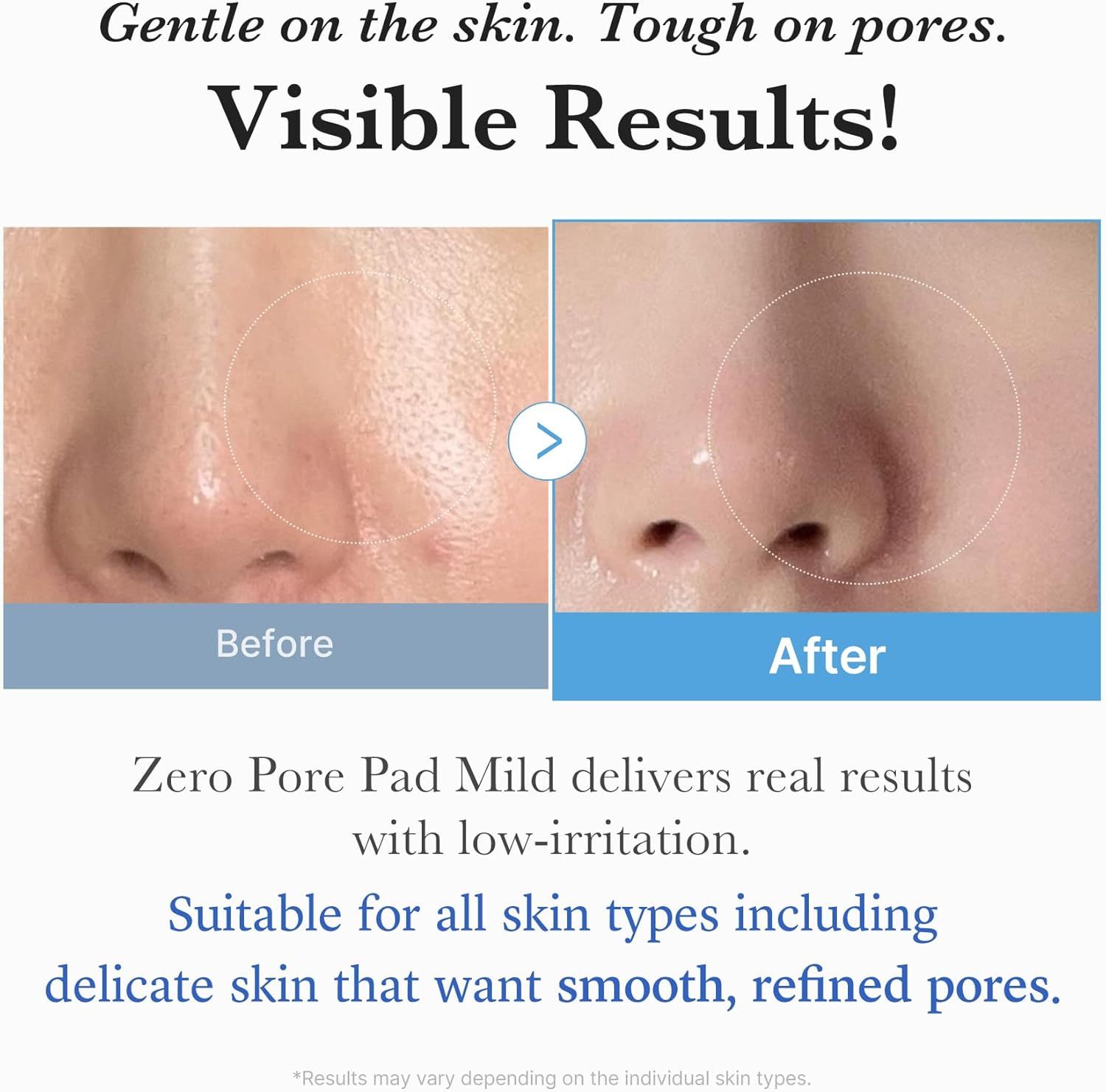 Demonstrates the visible transformation in skin texture and pore appearance after using the Zero Pore Pad Mild, proving the product's effectiveness at refining pores while being gentle on skin.