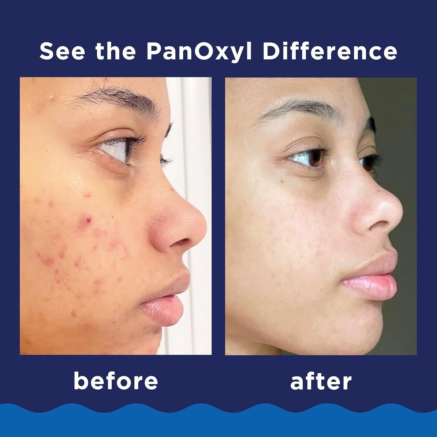 Demonstrates the transformative effectiveness of PanOxyl in clearing acne and improving skin appearance, providing visual proof of results to build shopper confidence.