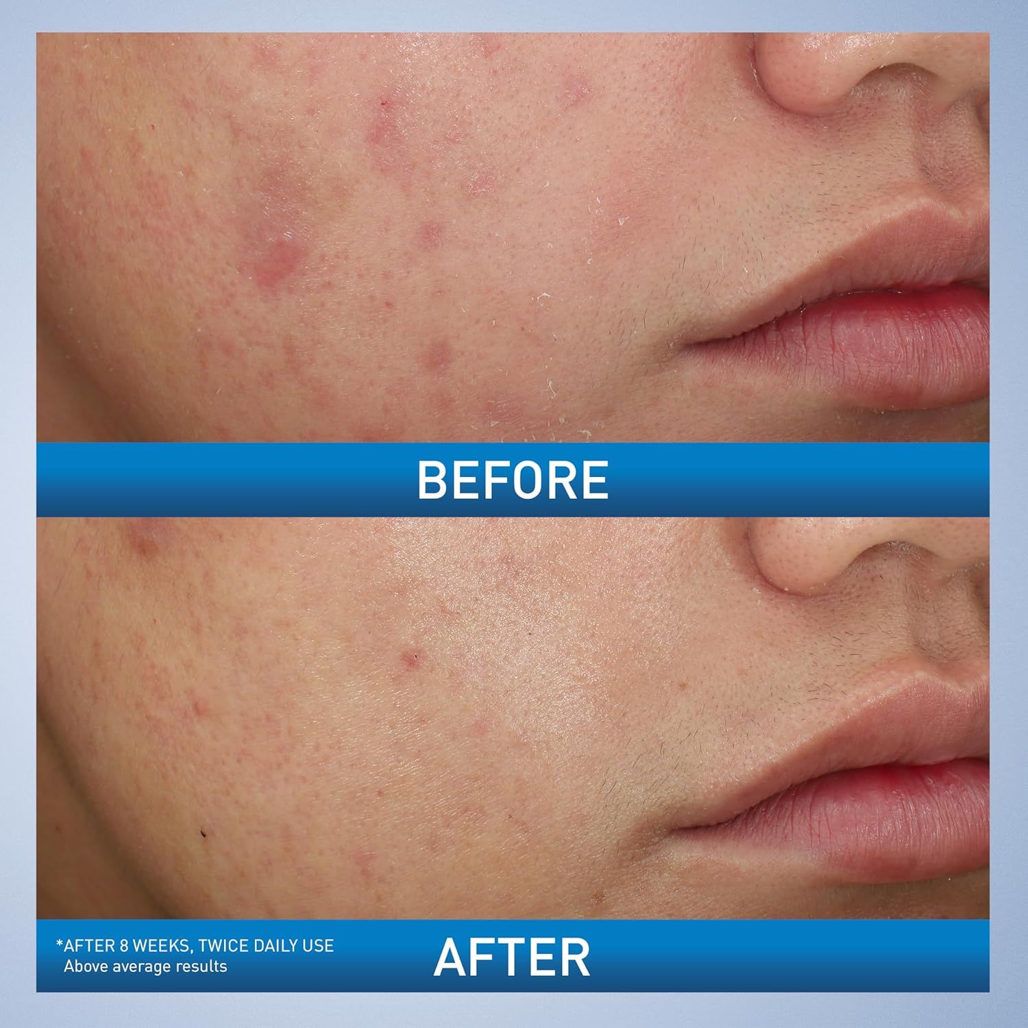 Demonstrates the visible transformation and effectiveness of the skincare product by showing reduced redness and improved skin clarity after 8 weeks of use.