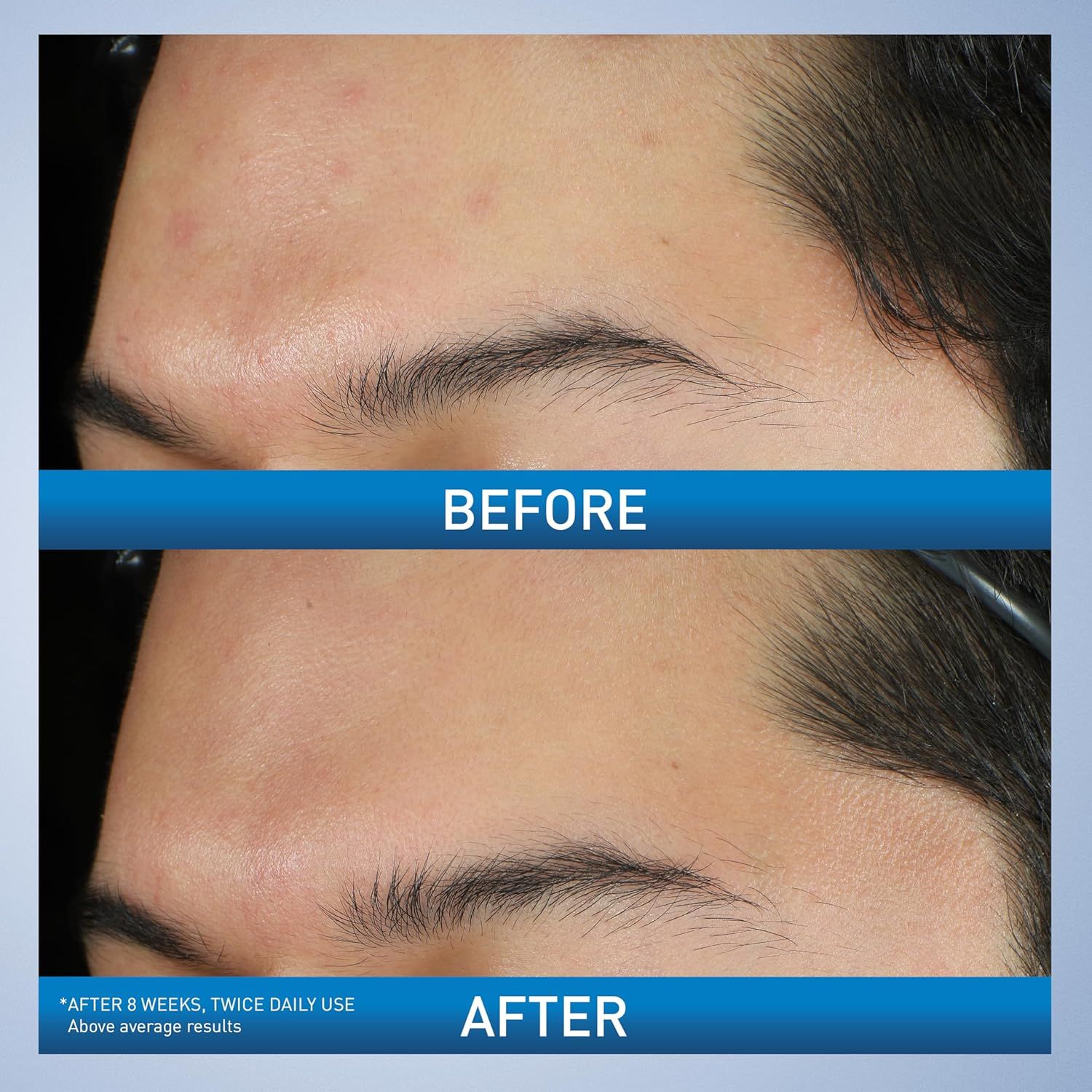 Demonstrates the visible transformation in skin condition after 8 weeks of twice-daily product use, showing reduced acne and improved skin clarity to prove product effectiveness.