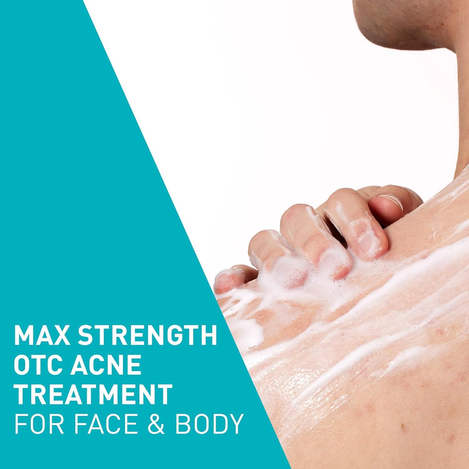Demonstrates that the acne treatment product can be used on multiple areas (both face and body), highlighting its versatility and broad application. Communicates the key benefit that this is the…